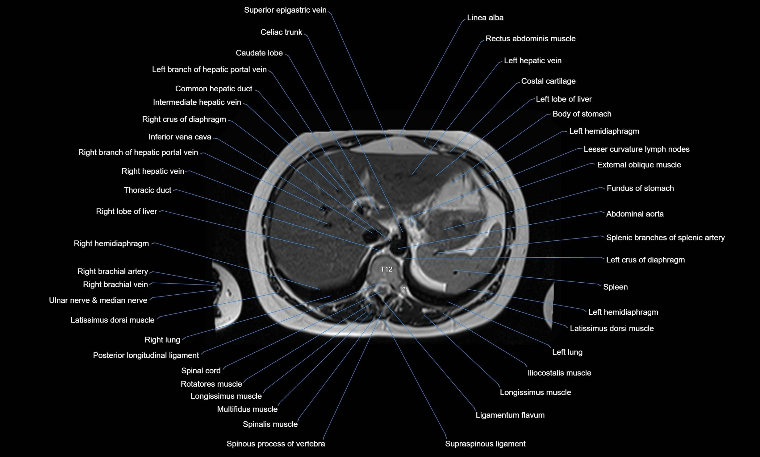 MRI chest axial  cross sectional anatomy 3T radiology  image-img-00001-00042.webp